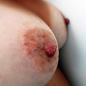 Cura dei capezzoli prima e durante l'allattamento Cura dei capezzoli prima e durante l'allattamento