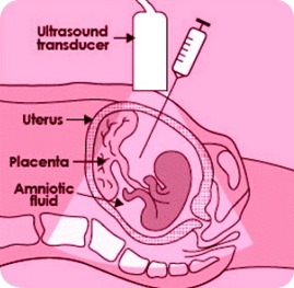 Harmony, l’esame del sangue che evita l’amniocentesi